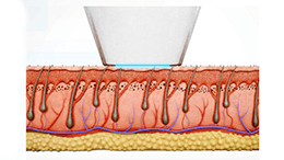 Épilation laser avec le LightSheer Duet