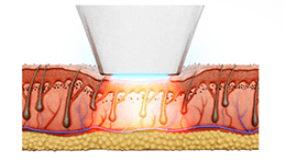 Épilation laser avec le LightSheer Duet