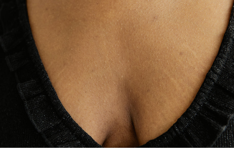 Vergetures sur les seins