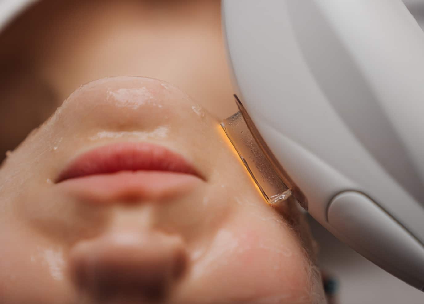 Photorajeunissement IPL/BBL