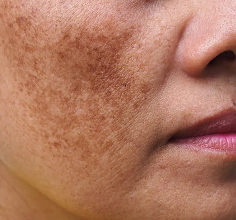 Tâches pigmentaires