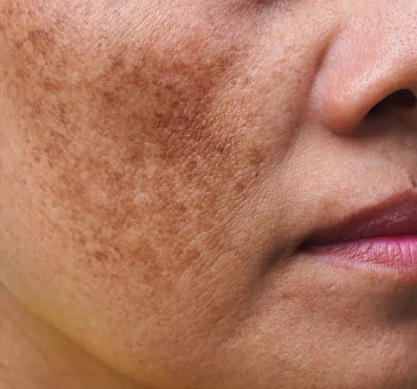 Mélasma