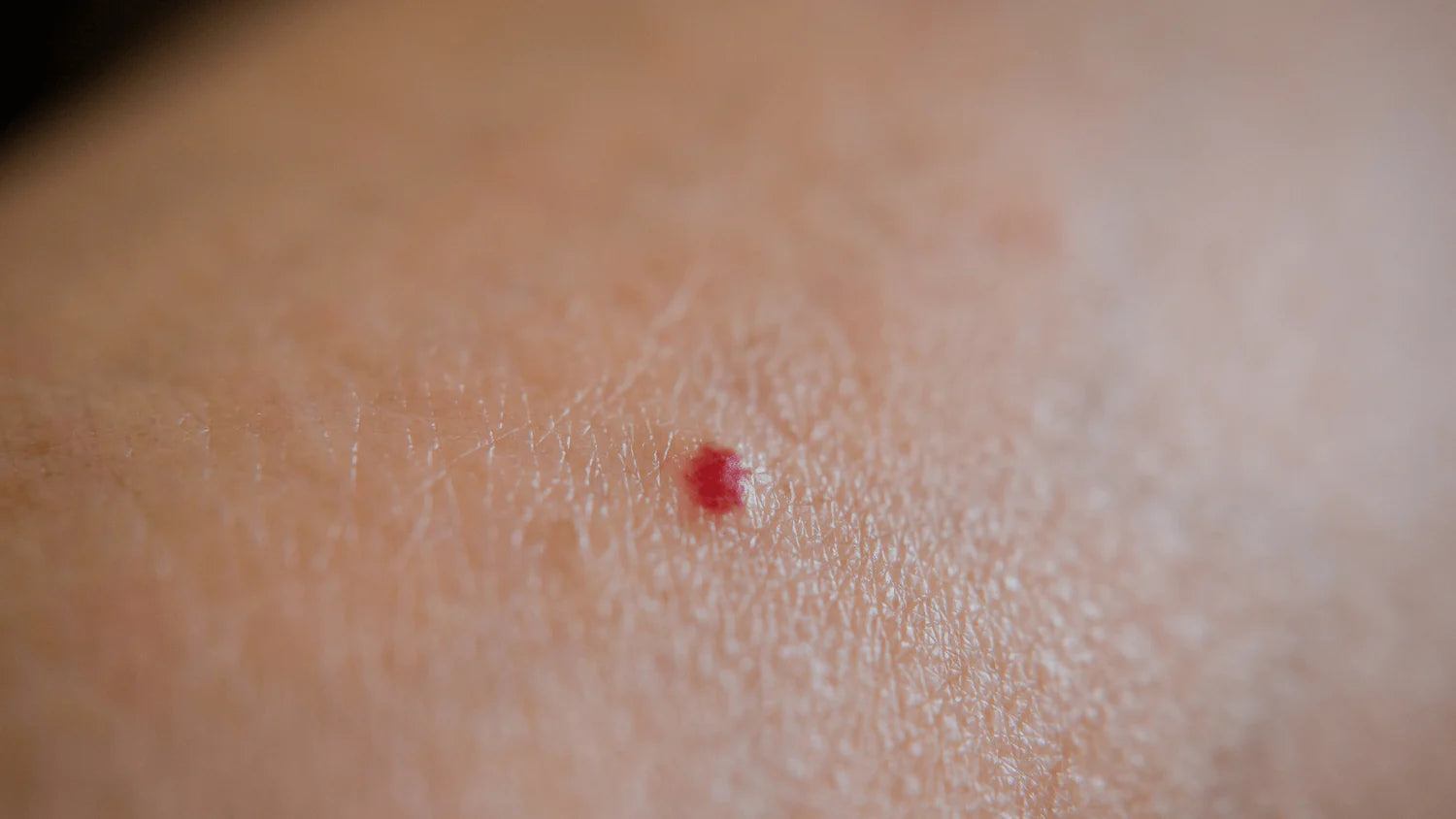 Papules rubi